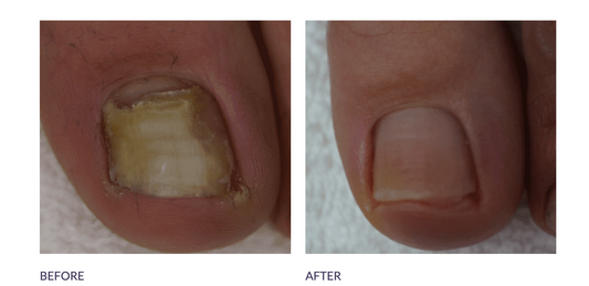 Footlogix Anti-Fungal Nail Tincture Spray
