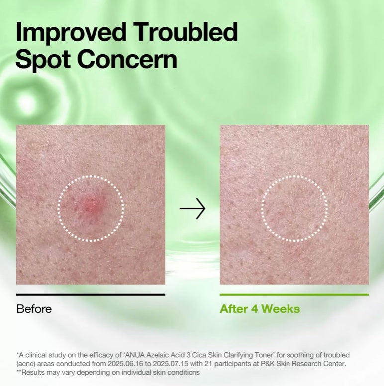 Before and after use results with Anua Azelaic Acid 3 Cica Toner
