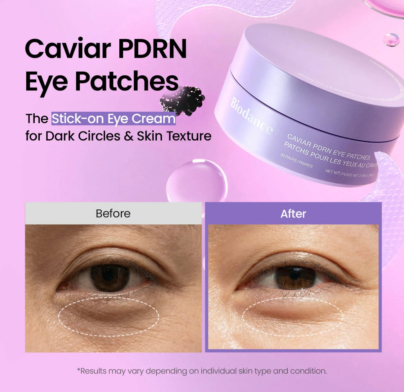 Results showing reduced dark circles and refreshed under eyes after using Biodance Caviar PDRN Eye Patches.