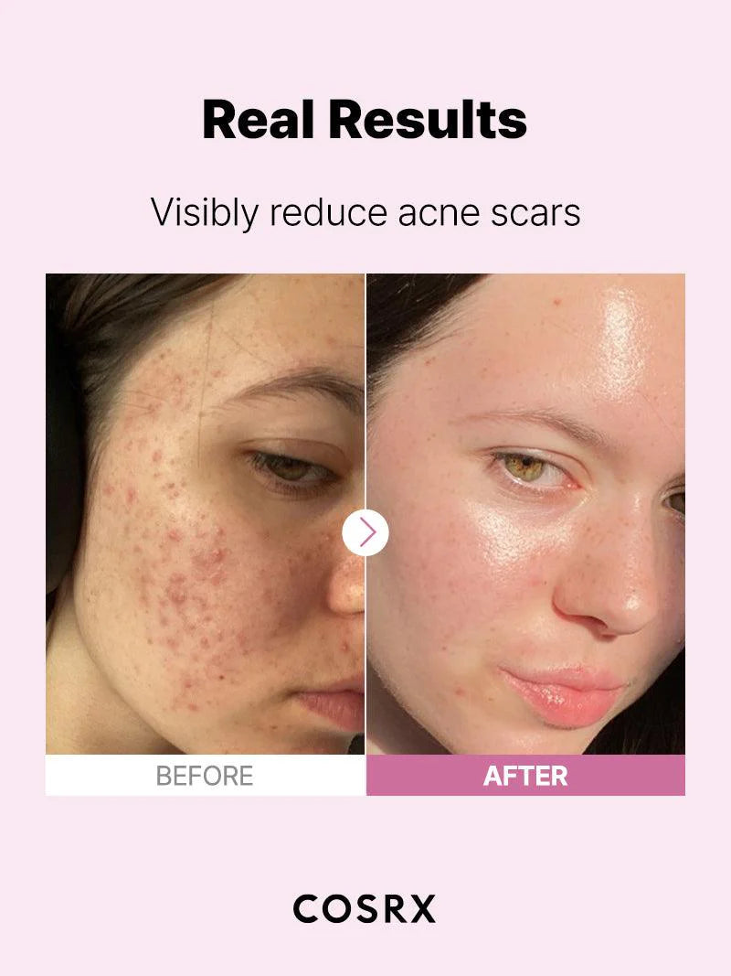 Before & after images showing reduced acne scars and improved skin texture after serum use.