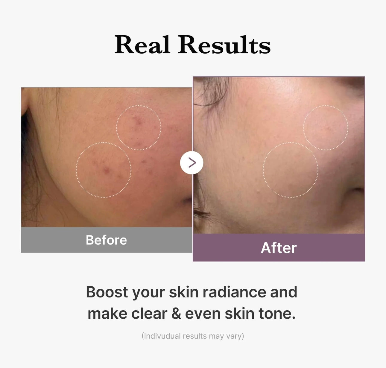 Before and after result of using Medicube Age R Glutathione Toner showing improved skin clarity and natural glow.